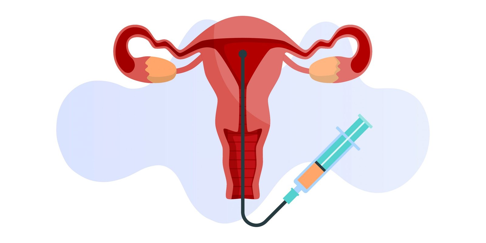 IUI